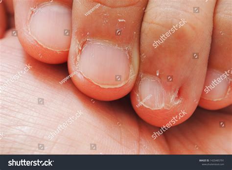 Fingernail Skin Peeling