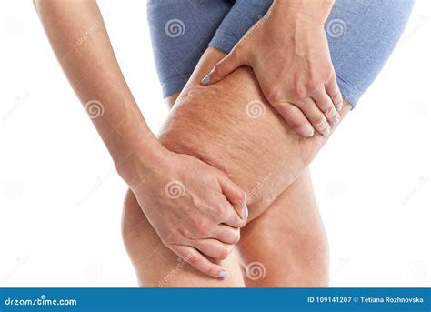 Cottage Cheese Legs Tumblr