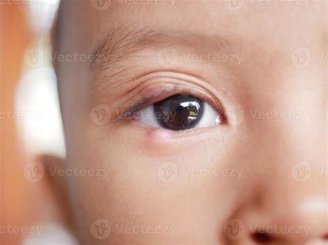 Red Bumps On Toddler Eyelid at JENENGE blog