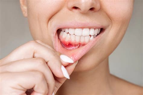 Symptoms of a Gum Infection and Treatment: How to Recognize and Address Gum Infections
