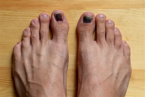Black Toenail Fungus: 10 Signs, Causes & Best Treatments