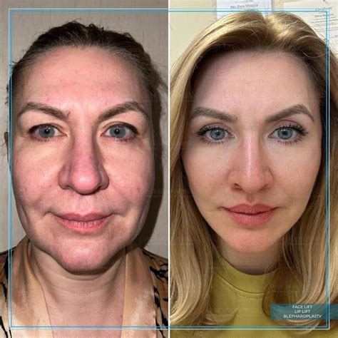 Best Facelift Surgeon Turkey - Ufuk Askeroğlu