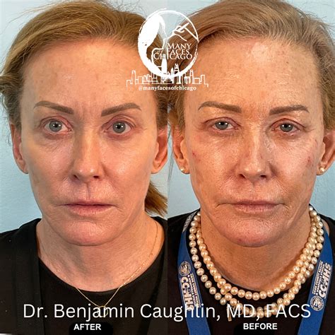 PERIORAL MOUND TREATMENT BEFORE & AFTER GALLERY