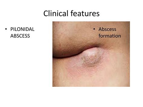 Pilonidal sinus 19 AUG 22.pptx