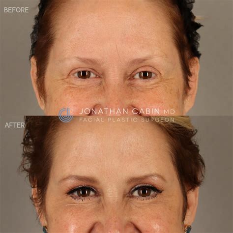 Masseter (TMJ) Botox / Non-Surgical Facial Slimming - Dr. Jonathan Cabin