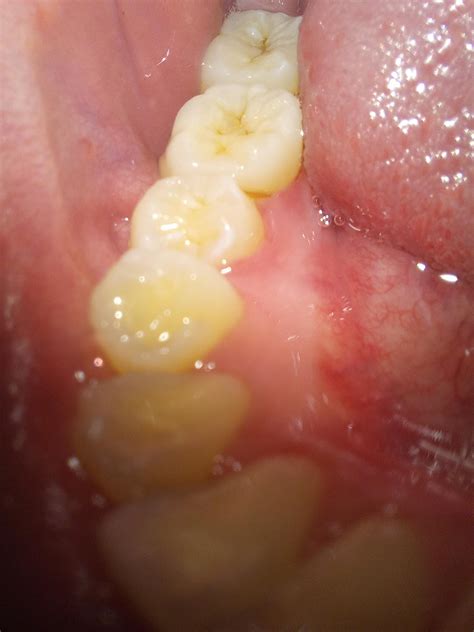 Are those cavities on my molars? Or just stains? : r/Teeth