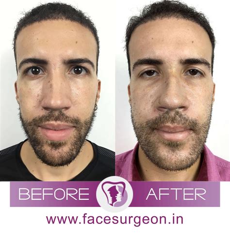 4 Things You Must Know About Paranasal Sinus Fracture Surgery – Richardson's Plastic Surgery ...