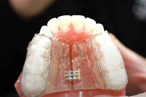 Palate Expander For 3 Year Old at Ronald Rodriquez blog