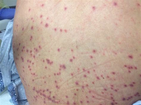 Disseminated Herpes Zoster Disseminated Zoster | New England Journal