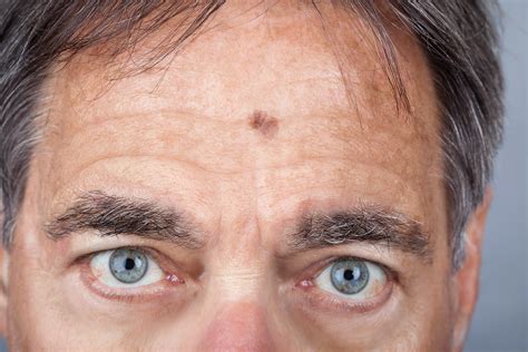 The FACE of Skin Cancer Treatment: Basal Cell Carcinoma and Mohs Surgery on the Forehead ...