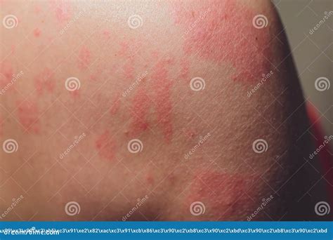 White Rash On Back – White Spots On The Skin – FBBLR