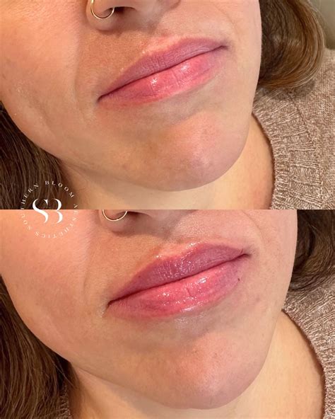 Stephanie Brady 🌸 DAXXIFY- DYSPORT- NATURAL RESULTS | We love PRF EZ Gel 😍 PRF EZ Gel was placed ...