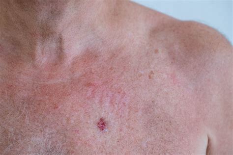 Where Can Skin Cancer Spread _ Stages of Skin Cancer: Melanoma, Squamous Cell, Basal Cell – JQMCLV