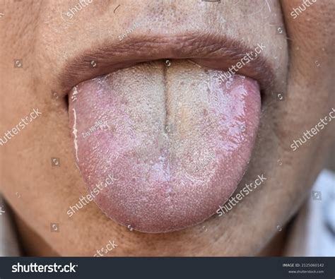 Dehydration Symptoms Tongue