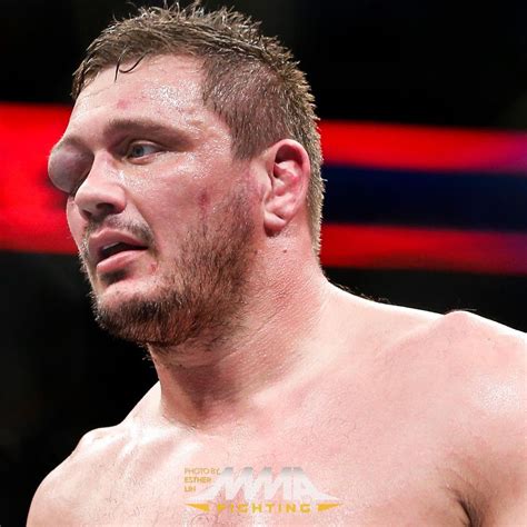 Fractured Orbital Bone