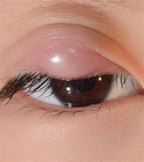 Blood In Baby Stool: 5 Causes, Diagnosis & Prevention Tips