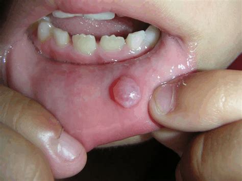 Mucocele Cancer Symptoms: Signs, Diagnosis, and Treatment Options