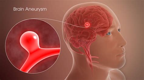 Brain Aneurysm: 9 Unusual Symptoms Of This Condition That Can Lead To ...