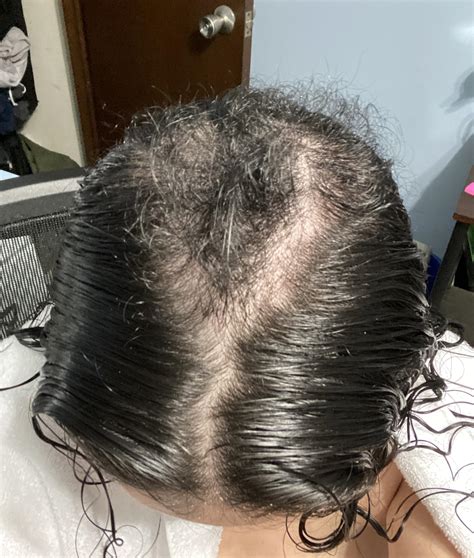 2 month regrowth update! : r/trichotillomania