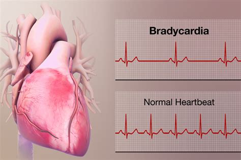 37 Facts About Bradycardia - Facts.net