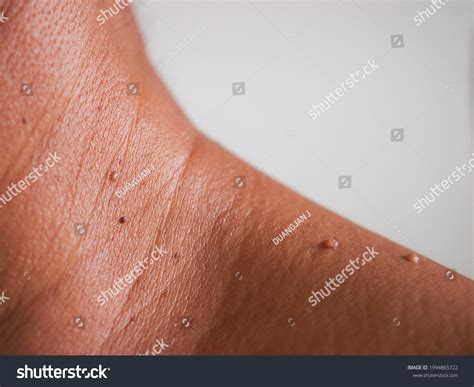 15,291 Skin Tag Images, Stock Photos & Vectors | Shutterstock