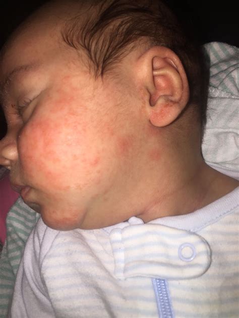 Baby Acne On Ears
