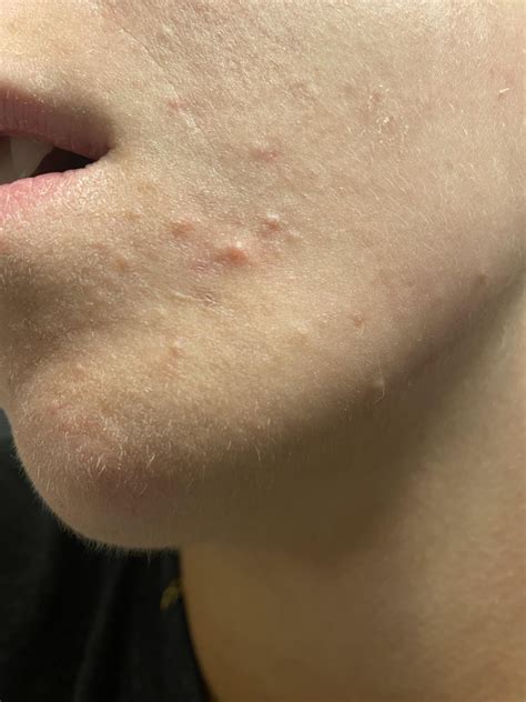 Small bumps below corners of mouth on chin : r/acne