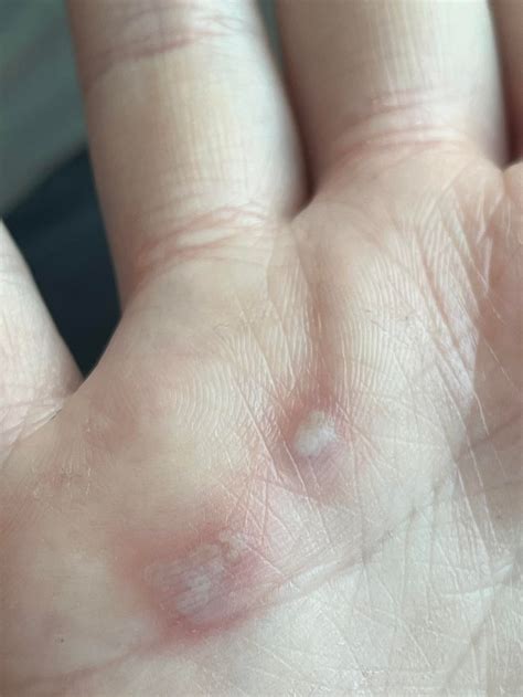 Anyone ever experienced this before? Blister type bumps on palm, painful and first and second ...