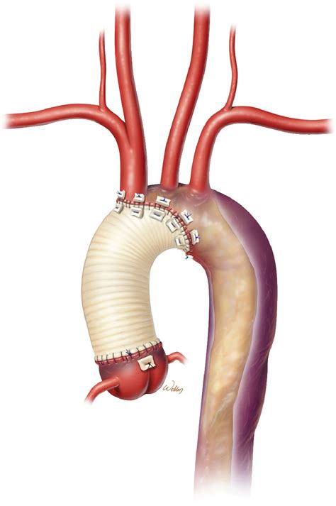 Contemporary Surgical Strategies for Acute Type A Aortic Dissection - Seminars in Thoracic and ...