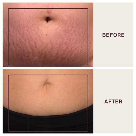 Dermaclara Silicone Stretch Marks Patch Kit | Scar Treatment Gel ...