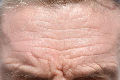 Static Wrinkles vs Dynamic Wrinkles: What's the Difference? - Freyja Medical