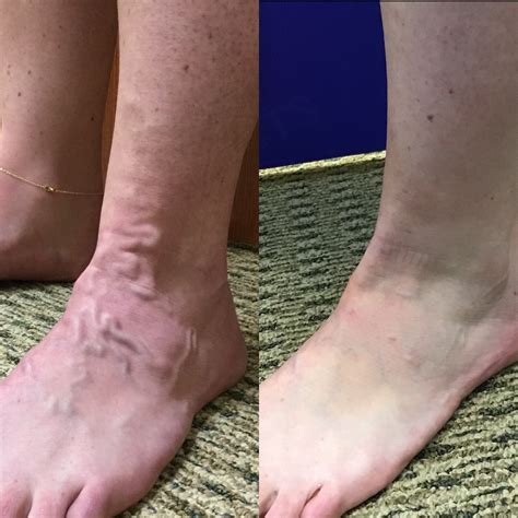 Varicose Veins In Feet Can Varicose Veins Cause Skin Discoloration?: