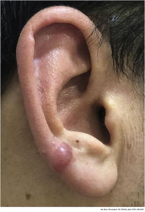 Keloid Piercing Cartilage
