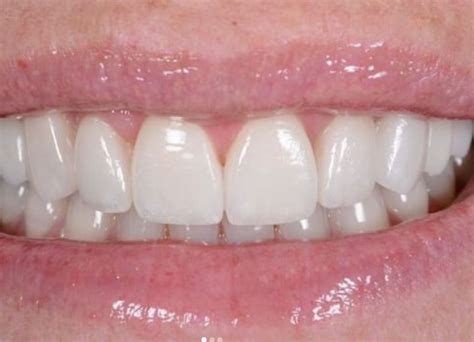 Gum Abscess Popped? Thinking of Popping It Yourself?