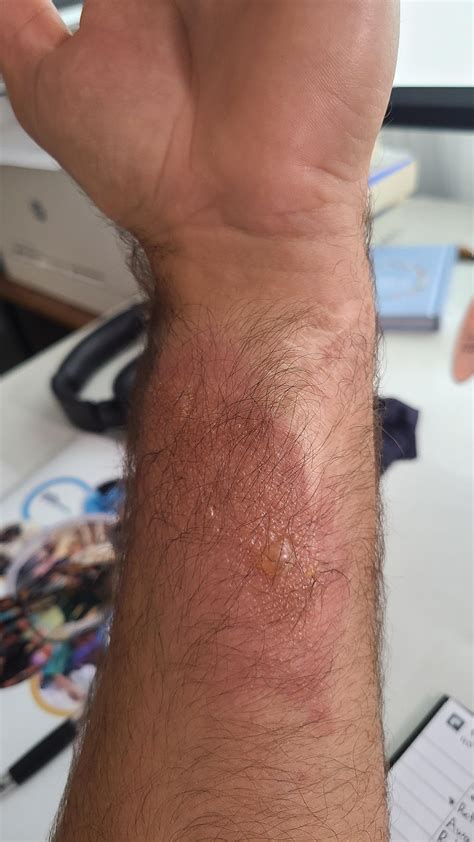 Worst Poison Ivy Rash On Face