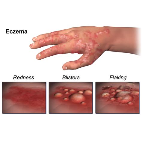 NIH-supported research demonstrates how genetic variations cause eczema ...