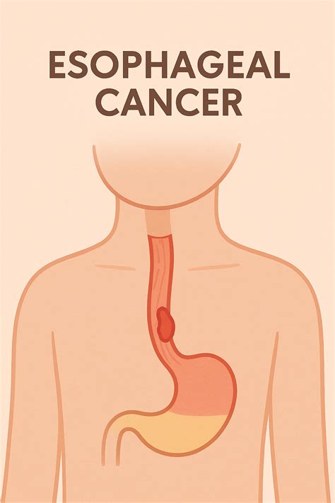 Understanding Esophageal Cancer: Symptoms, Causes, and Early Detection – HOMEDSUN STORE