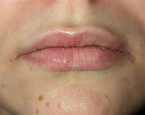 Gf has these bumps appear on her lips every few months out of nowhere ...