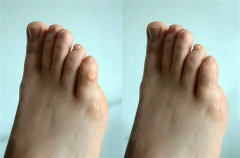 What to Know About Corn Removal Surgery Before And After