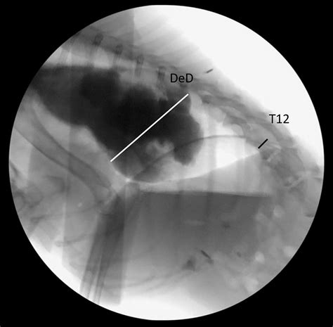 Videofluoroscopic swallow study features of lower esophageal sphincter ...