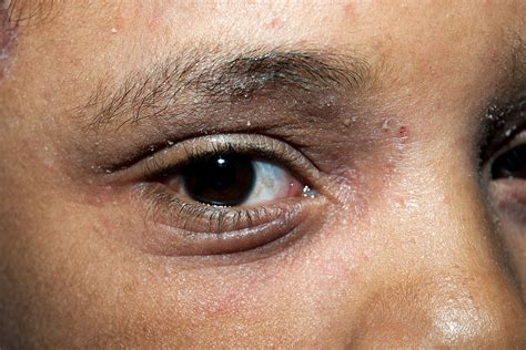 Eczema On Eyelids And Face