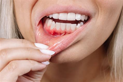 How to Cure Gum Disease Without a Dentist - Is It Possible?!