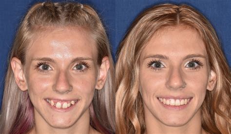 Before & Afters | Parks, Schmit & Fuller Orthodontics