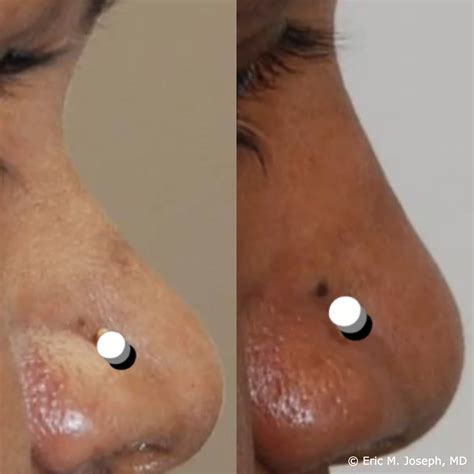 Eric M. Joseph, MD | Silikon-1000 Before & After: To Raise a Flat Nasal ...