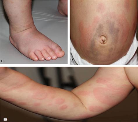 Serum sickness causes, symptoms, diagnosis, treatment & prognosis