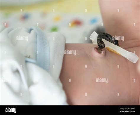 Umbilical Cord Infection