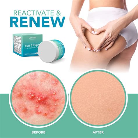 Vanibiss Butt & Thighs Acne Treatment Cream - Clear Pimples, Zits, Razor Bumps & Dark Spots ...