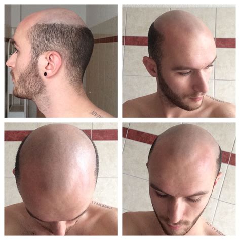 How To Style Hair With Male Pattern Baldness at Clara Moran blog