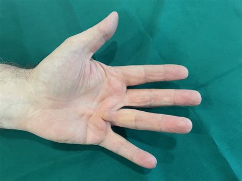 Dupuytrens Contracture Dupuytrens Contracture & Other Conditions Of