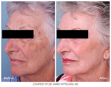 Erbium Laser Skin Resurfacing - A Younger You Med Spa DeLand FL | Botox, Laser Treatments, Facials